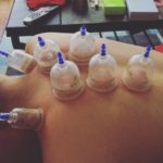 Cupping for Headaches and Migraines