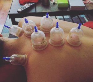 Cupping for Headaches and Migraines
